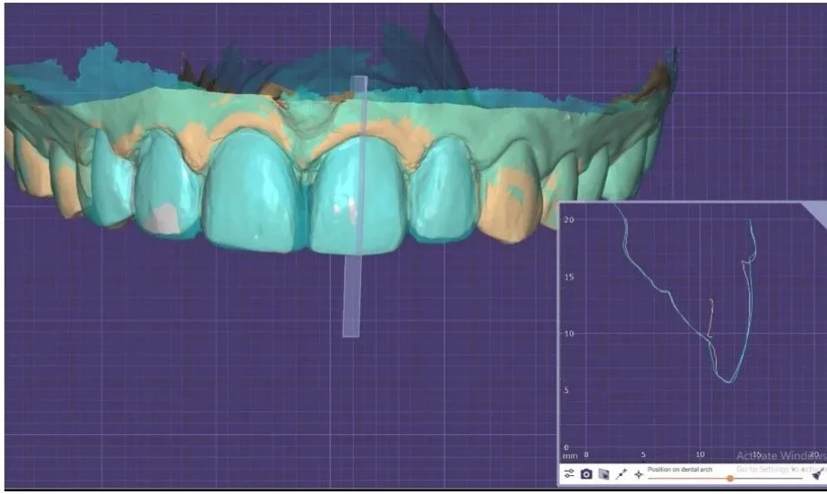 Digital Smile design software screenshot of teeth for a dentistry assessment