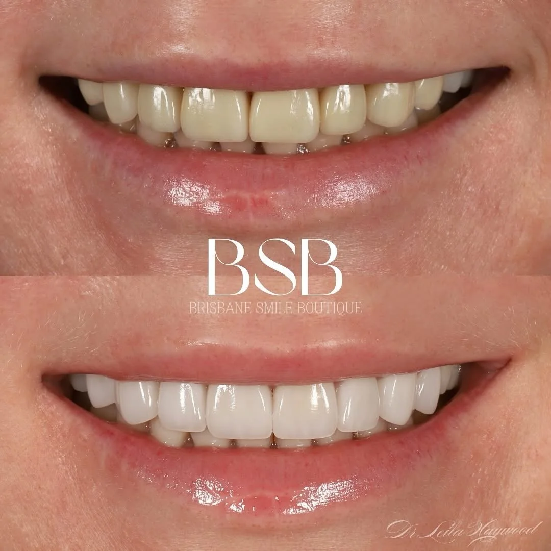 before and after photos of a woman's smile after highest aesthetic porcelain Minimal preparation veneers at Brisbane Smile boutique, with one of Brisbane's most accomplished female cosmetic dentists, Dr Leila Haywood in Spring Hill