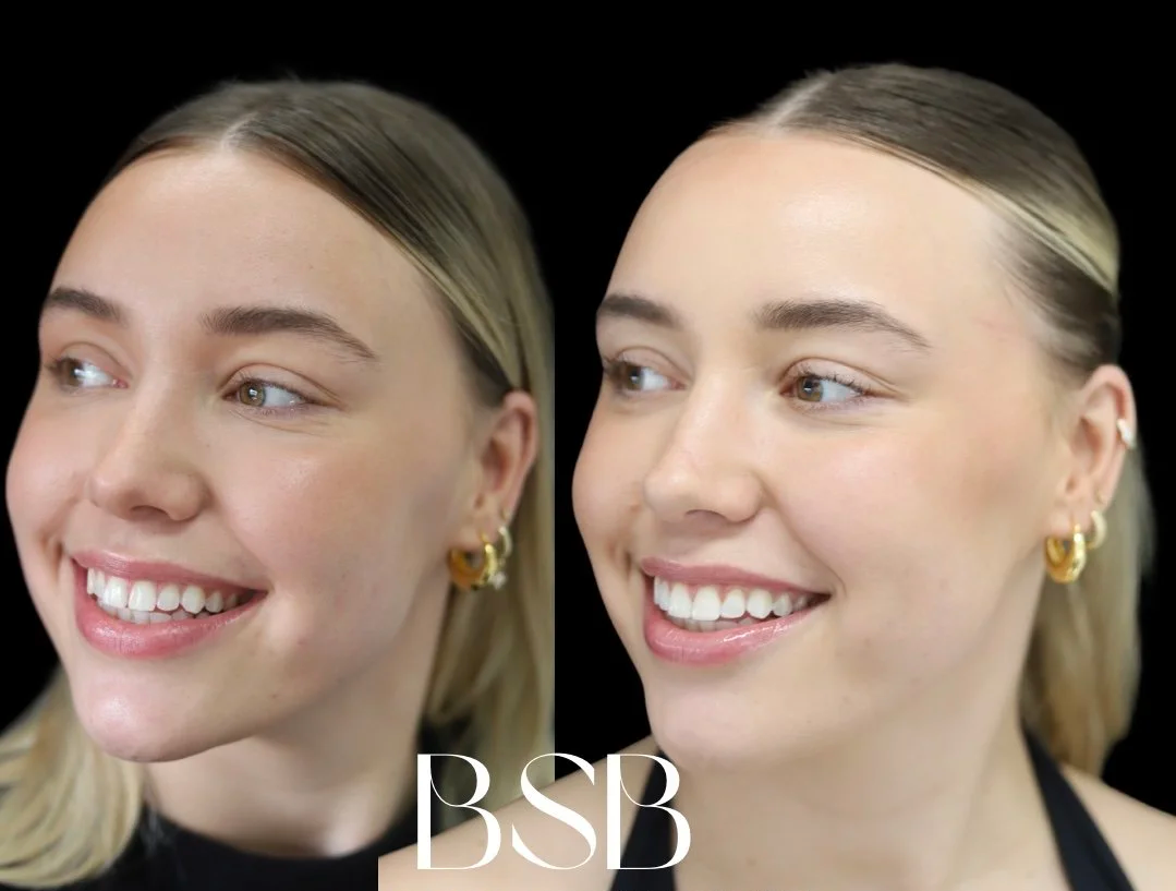before and after images of composite resin veneers by Dr Leila Haywood