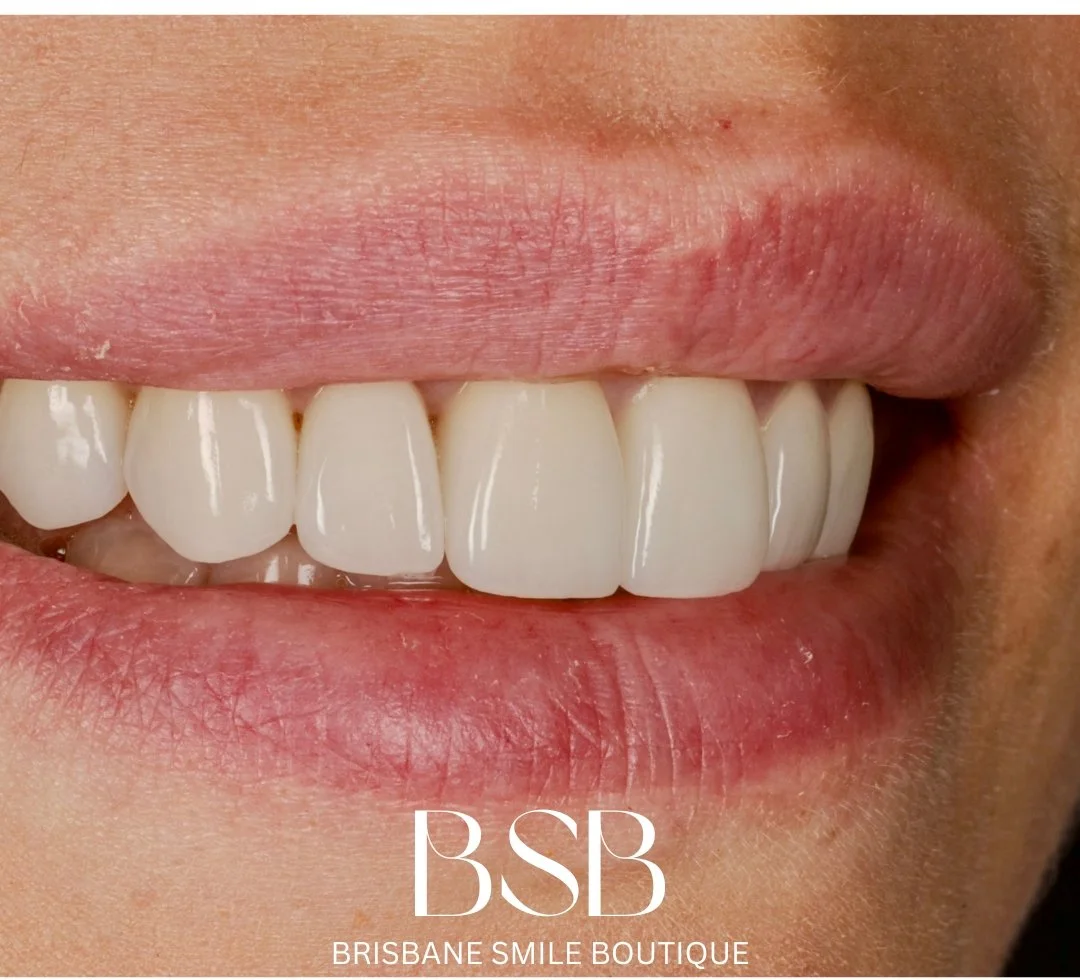 A smile photo of porcelain veneers by dr leila haywood, a cosmetic female dentist at Brisbane smile boutique in Spring Hill, inner city Brisbane