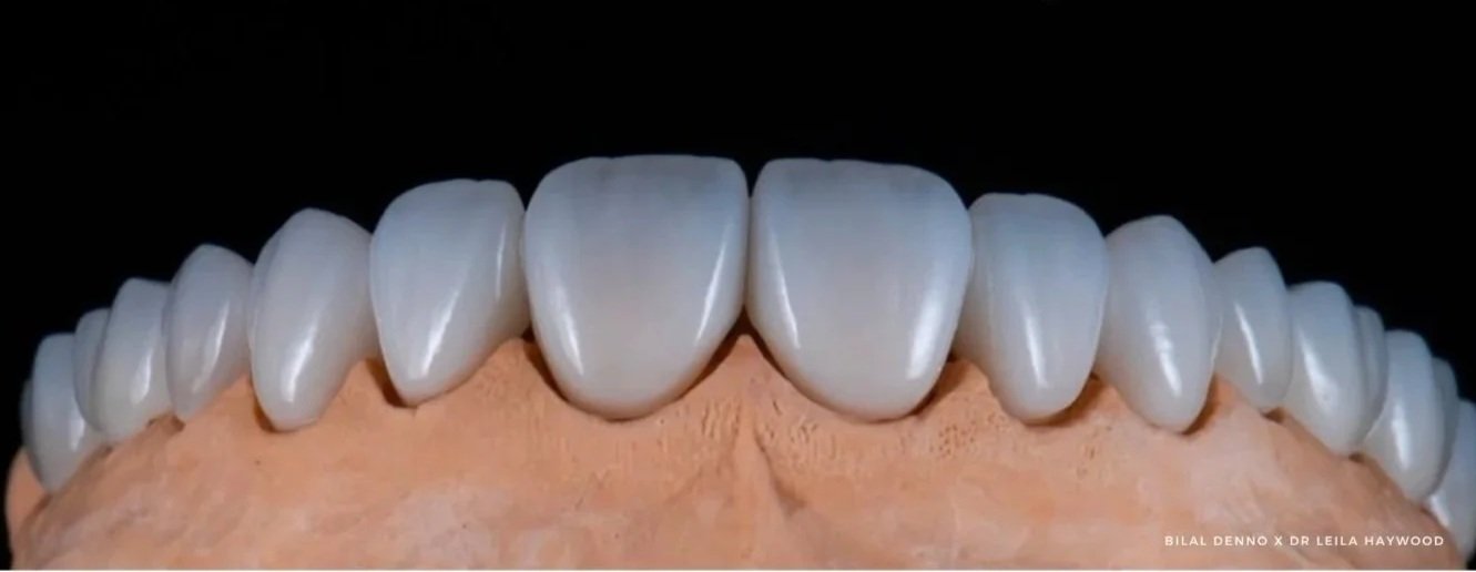 Dental crowns on a model for a complete new smile makeover