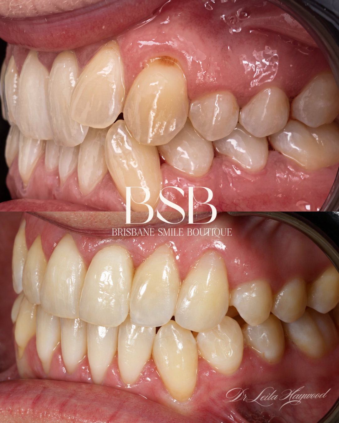 Before and after image of invisalign dental treatment followied by conservative composite resin bonding