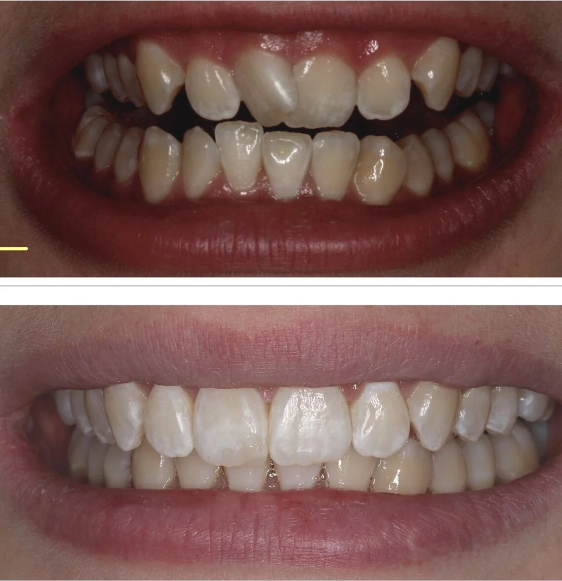 Invisalign Brisbane Smile Boutique