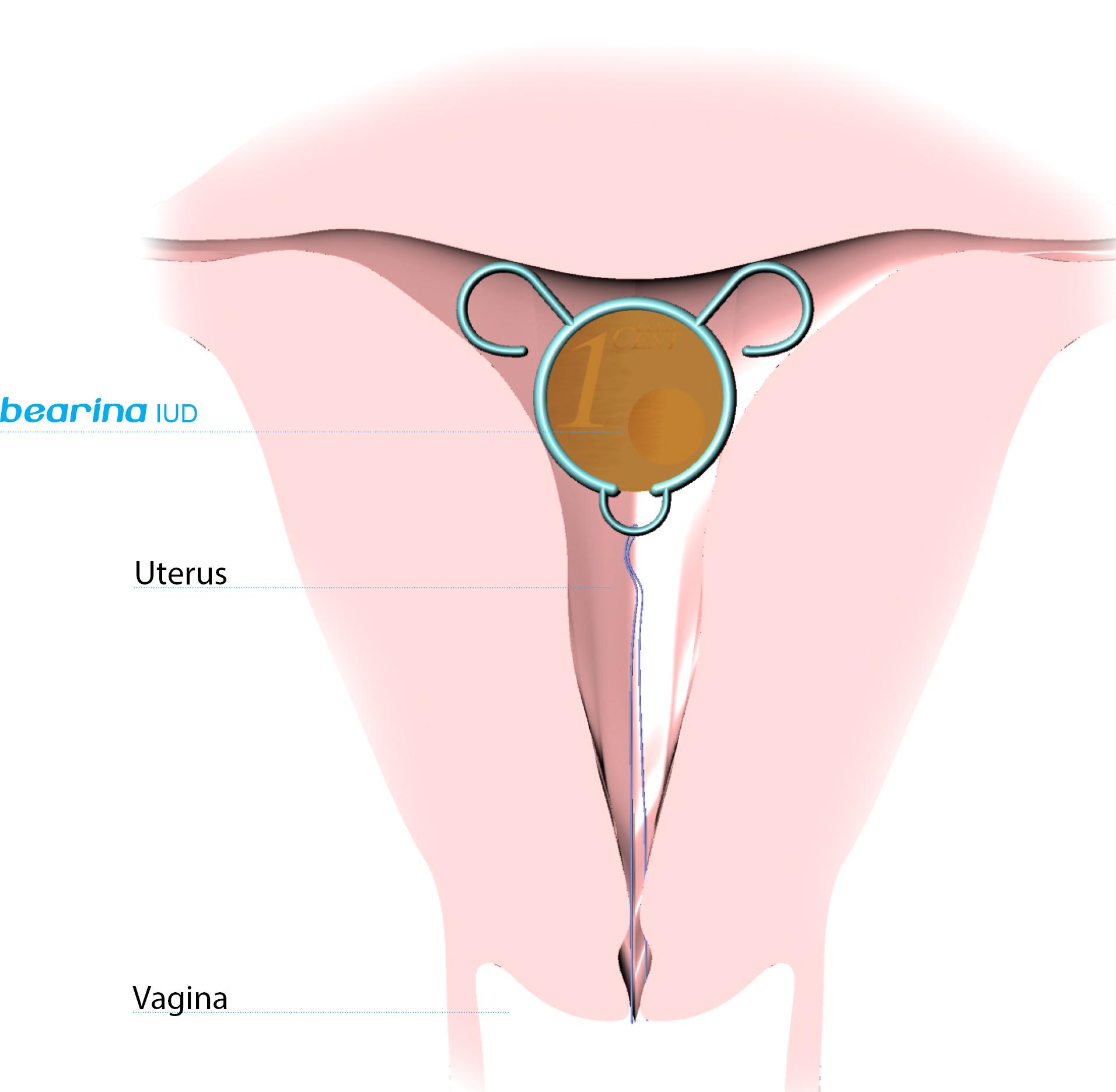 Kadushin-Bearina IUD concept-MR2.jpg