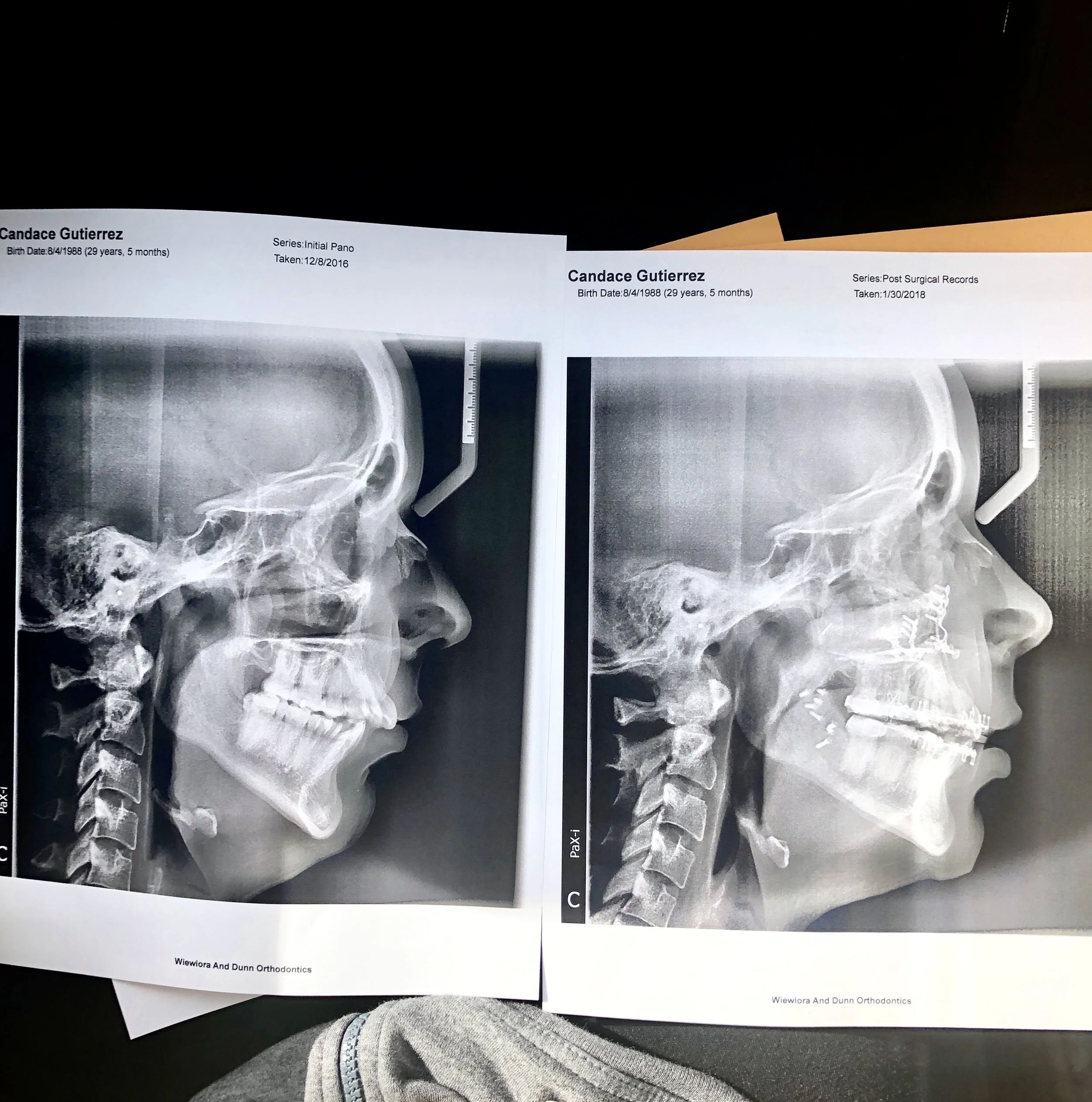 Corrective Double Jaw Surgery