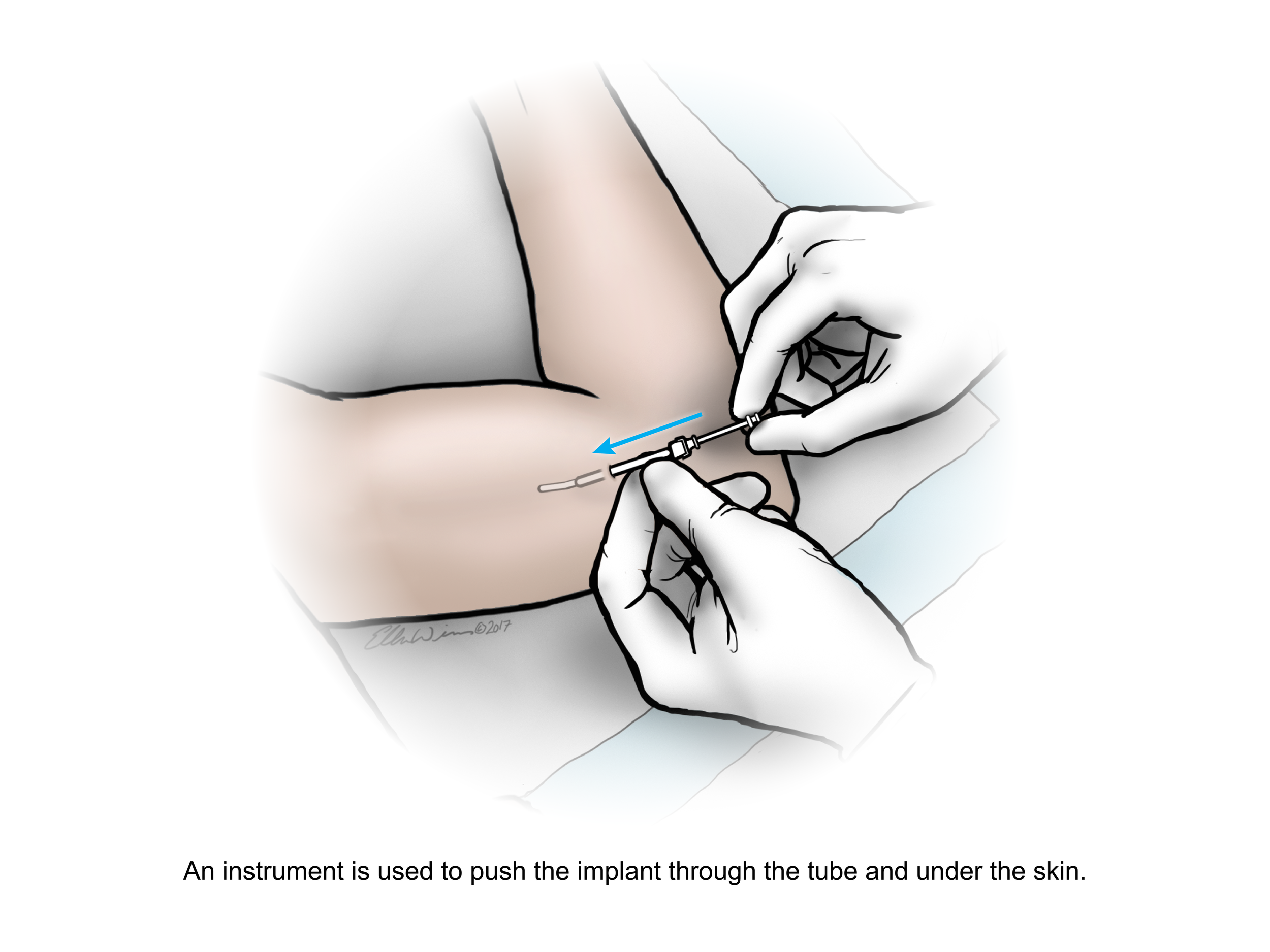 Anti-HIV2_0005_insertion5_text.png
