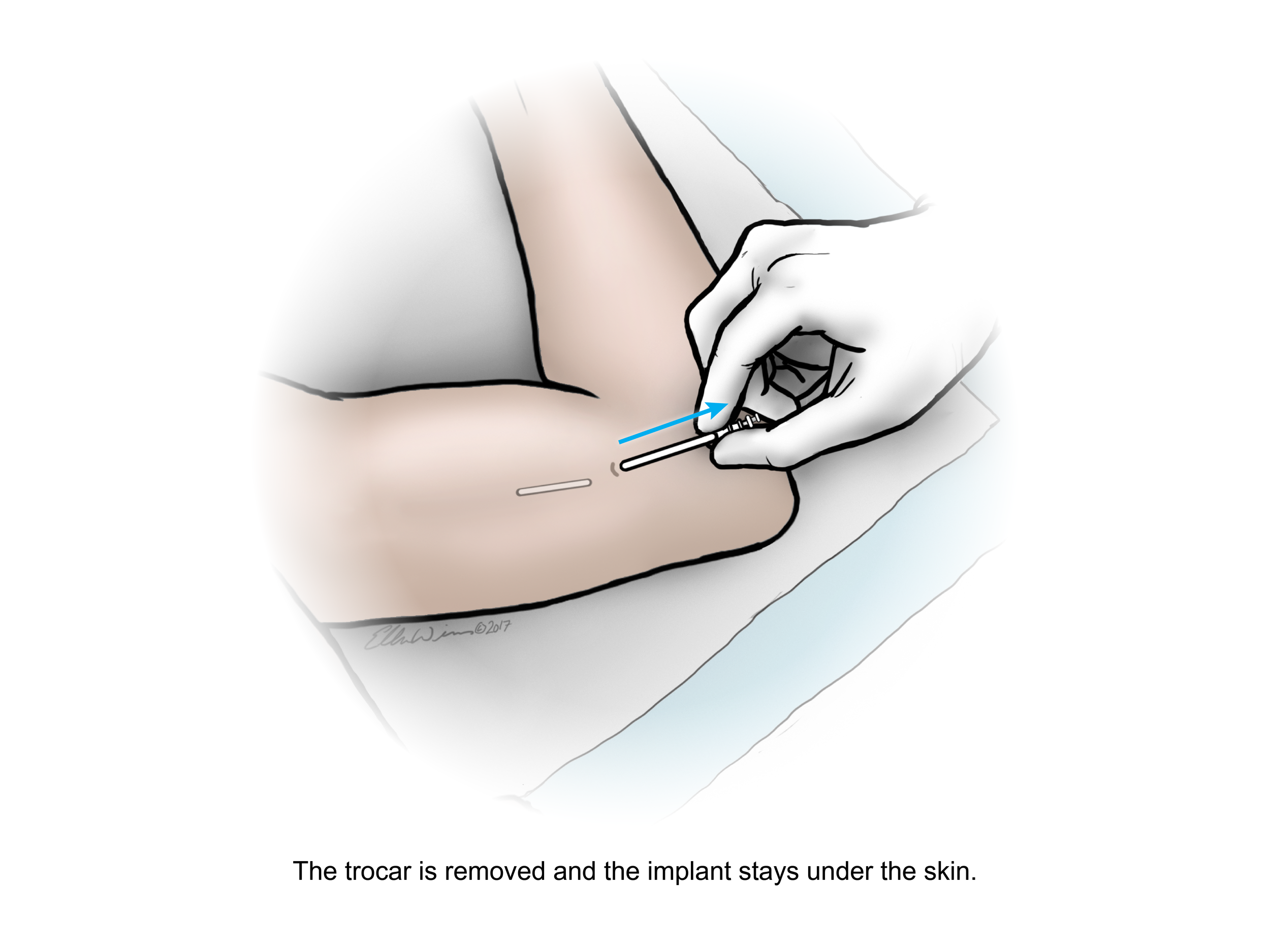 Anti-HIV2_0006_insertion6_text.png