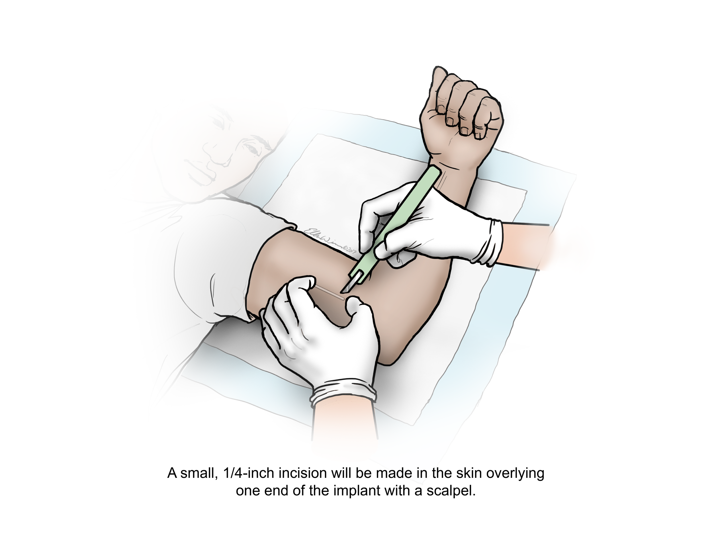 Anti-HIV2_removal3_text.png