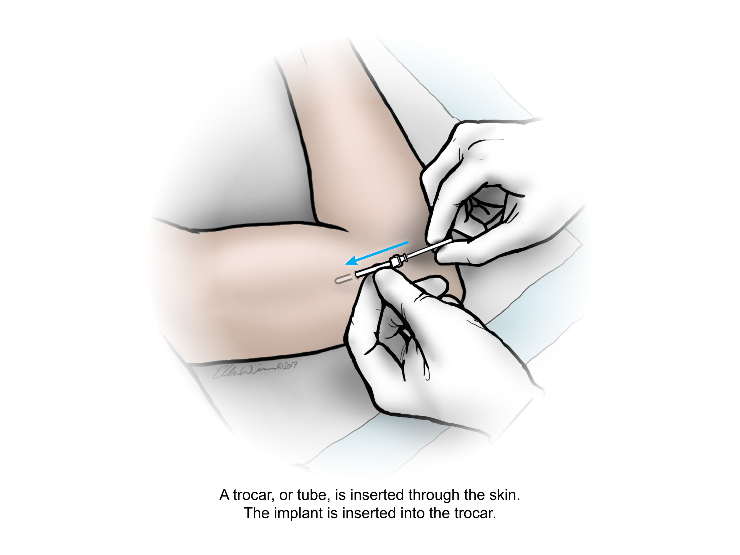 Anti-HIV2_0004_insertion4_text.png