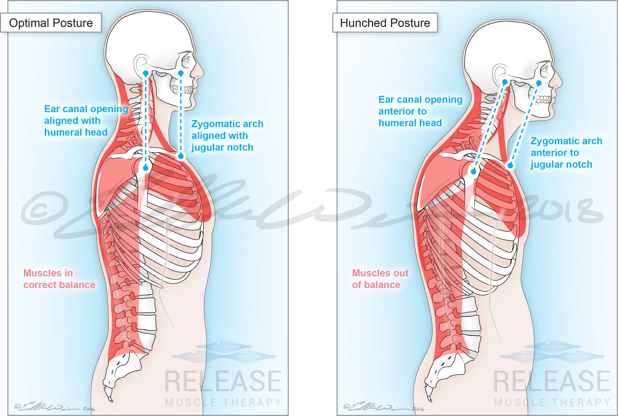 UpperCrossSyndrome_Illustration_Visnic_Draft07_AllRed_20180331_watermark.jpg