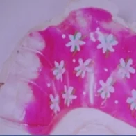A Palatal Appliance fits in the roof of the mouth and is made of acrylic and metal. It helps straighten the upper front teeth, often correcting a crossbite (lower teeth in front of the upper teeth). The doctor will adjust small springs that rest on the inside of your upper front teeth. To work properly, this appliance must be worn as directed and it is removable. Colors and design options can be customized.