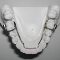 The Lower Lingual Holding Arch (LLHA) is a space maintaining appliance. It consists of two metal bands attached to the lower first molars connected by a wire that runs along the inside of your lower teeth. The purpose of this appliance is to prevent your lower molars from moving. The LLHA is not a removable device.
