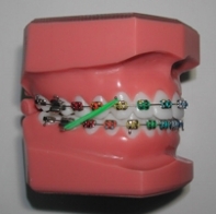 Rubber Bands - also called Elastics - are used to produce tooth moving forces on the teeth. They are attached between two different teeth, usually from one jaw to the other.