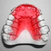 The Bite Plate Appliance is a retainer-type appliance that fits closely to the top of your mouth. It is made of acrylic and metal. It can be used before or during braces to open the bite and separate the back teeth, promoting their eruption. In order for it to be effective, the bite plate appliance must be worn 24/7 unless instructed by the doctor. The bite plate is removable.