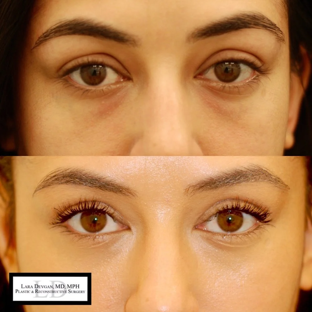 dr lara devgan eye cream