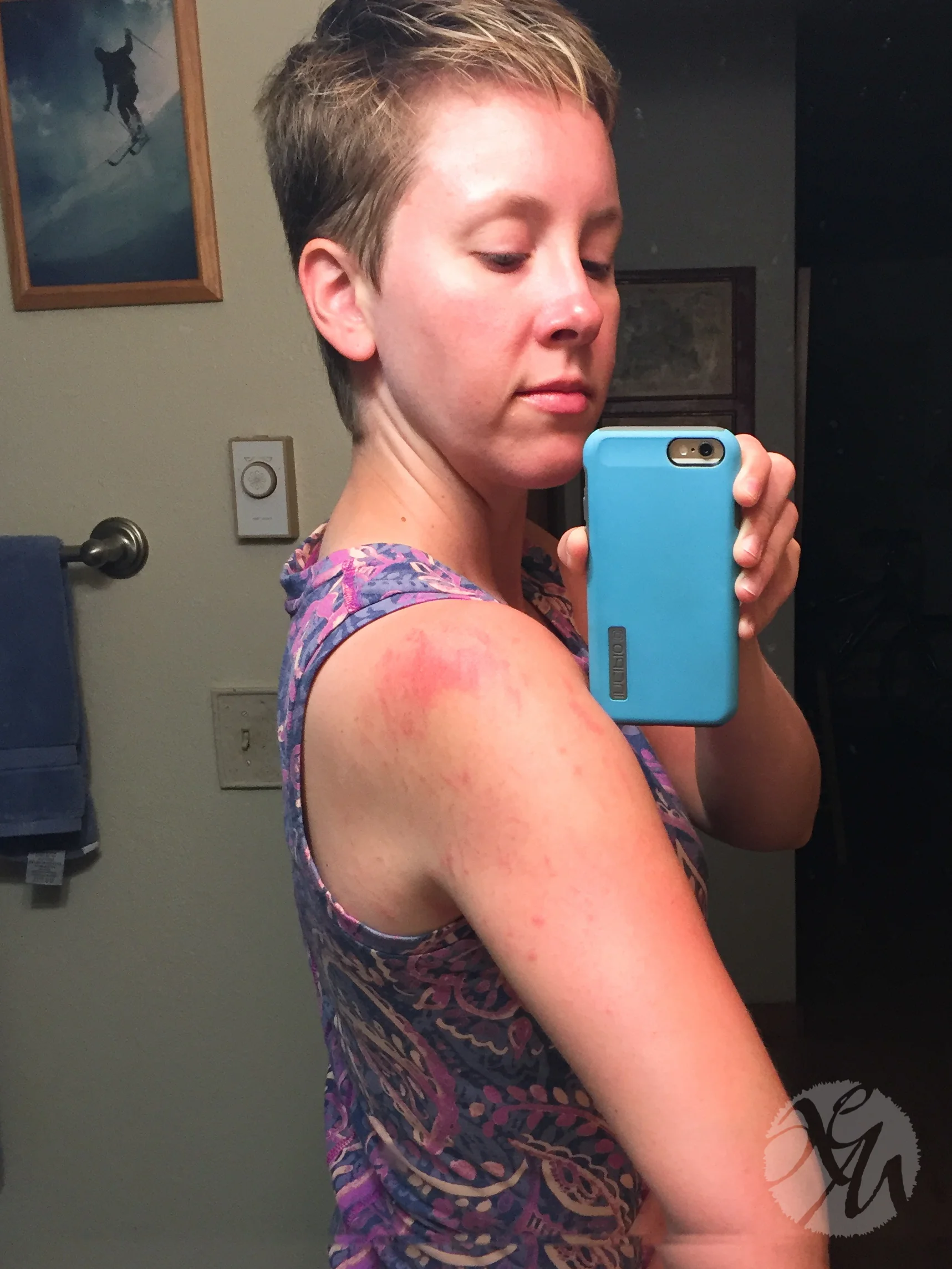 I think I had what you'd call "grass burn."