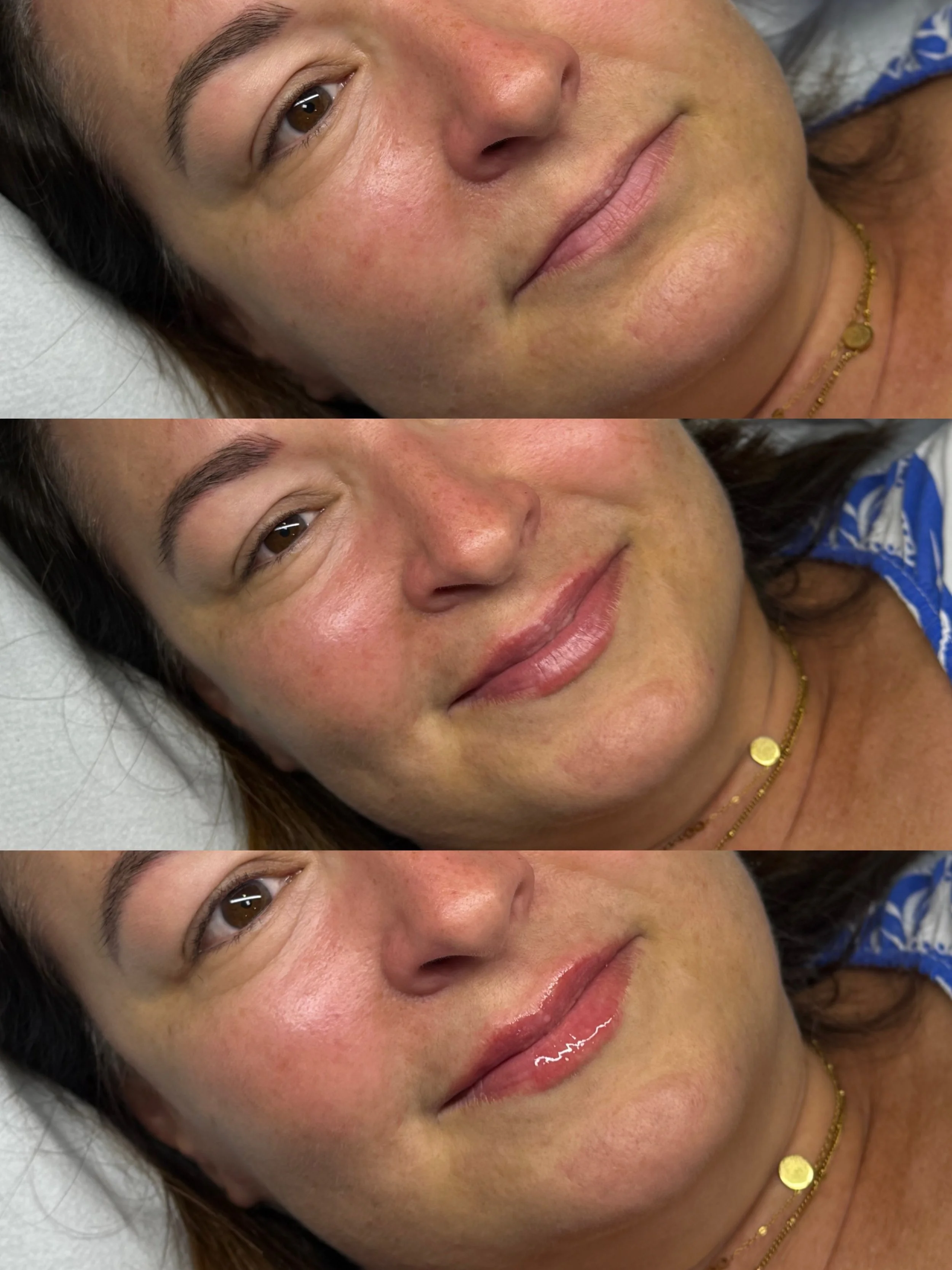 Natural Lip Filler Before &amp; After | KMS Beauty Reading