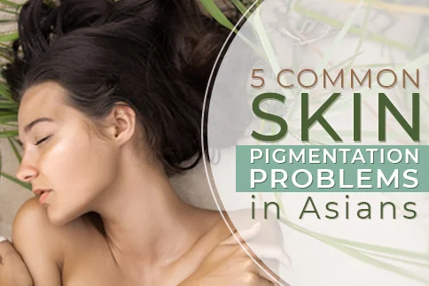5 Common Skin Pigmentation Problems in Asians