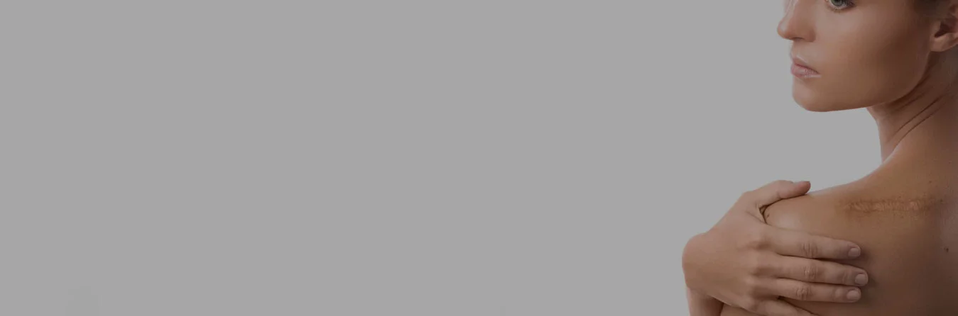 keloid-treatment-header.jpg