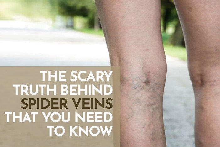 The Truth Behind Spider Veins that You Need to Know — Skin MD -  Dermatologist in Ortigas, Pasig