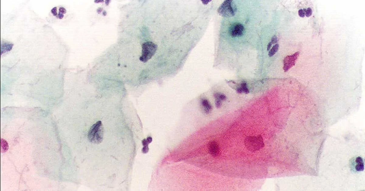 The importance of smear tests