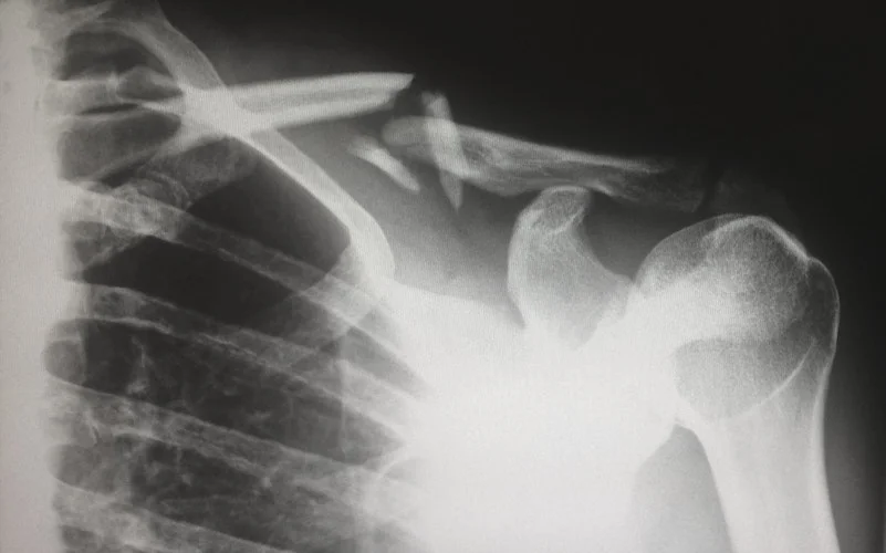 Research Reports Increased Fracture Risks in People with Lupus