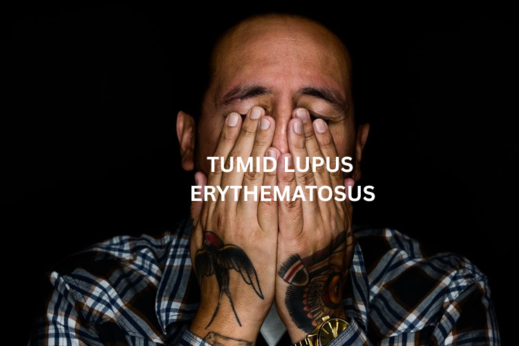 TUMID LUPUS ERYTHEMATOSUS (1).png