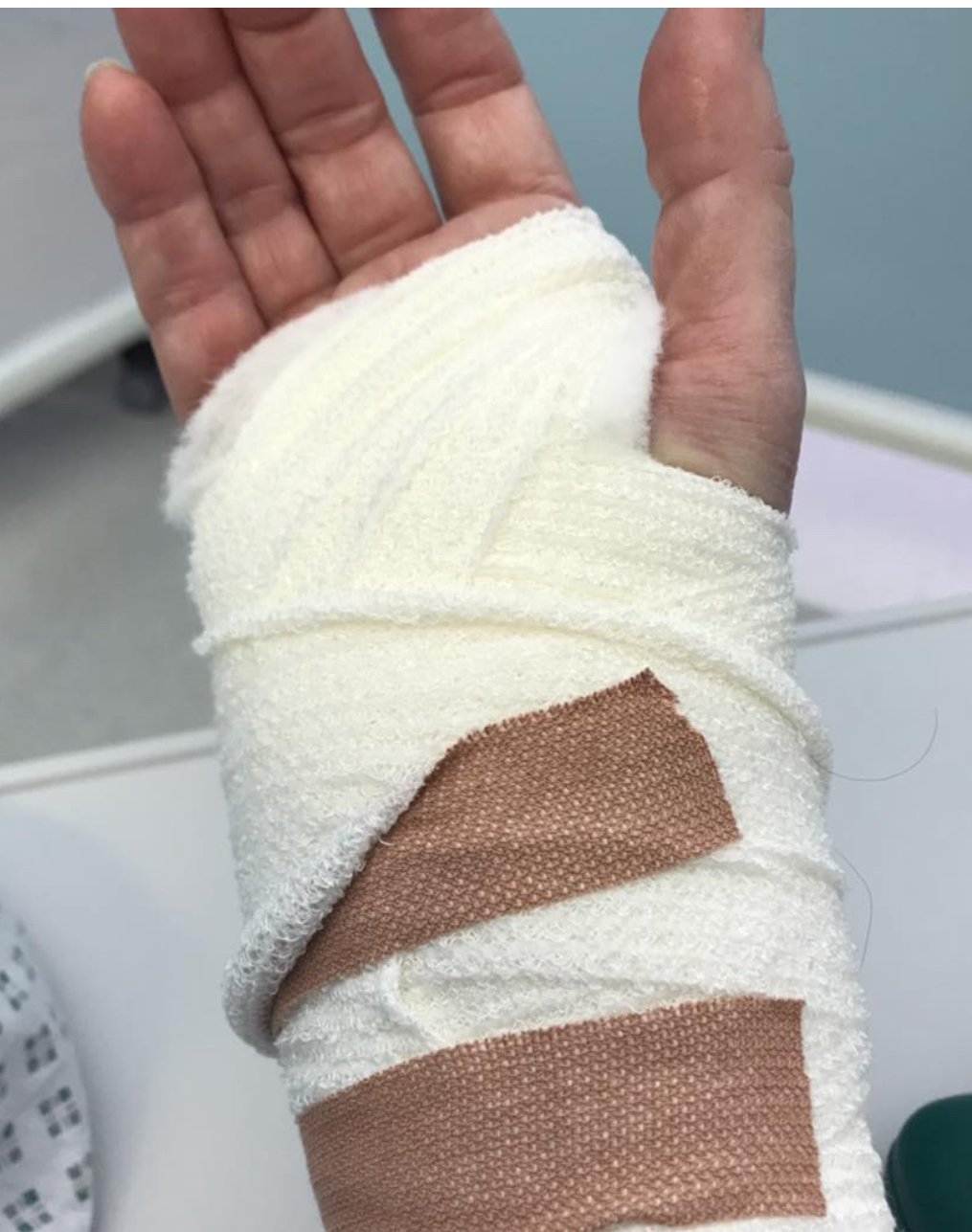Why??? Big bandage after stitches removed. : r/carpaltunnel