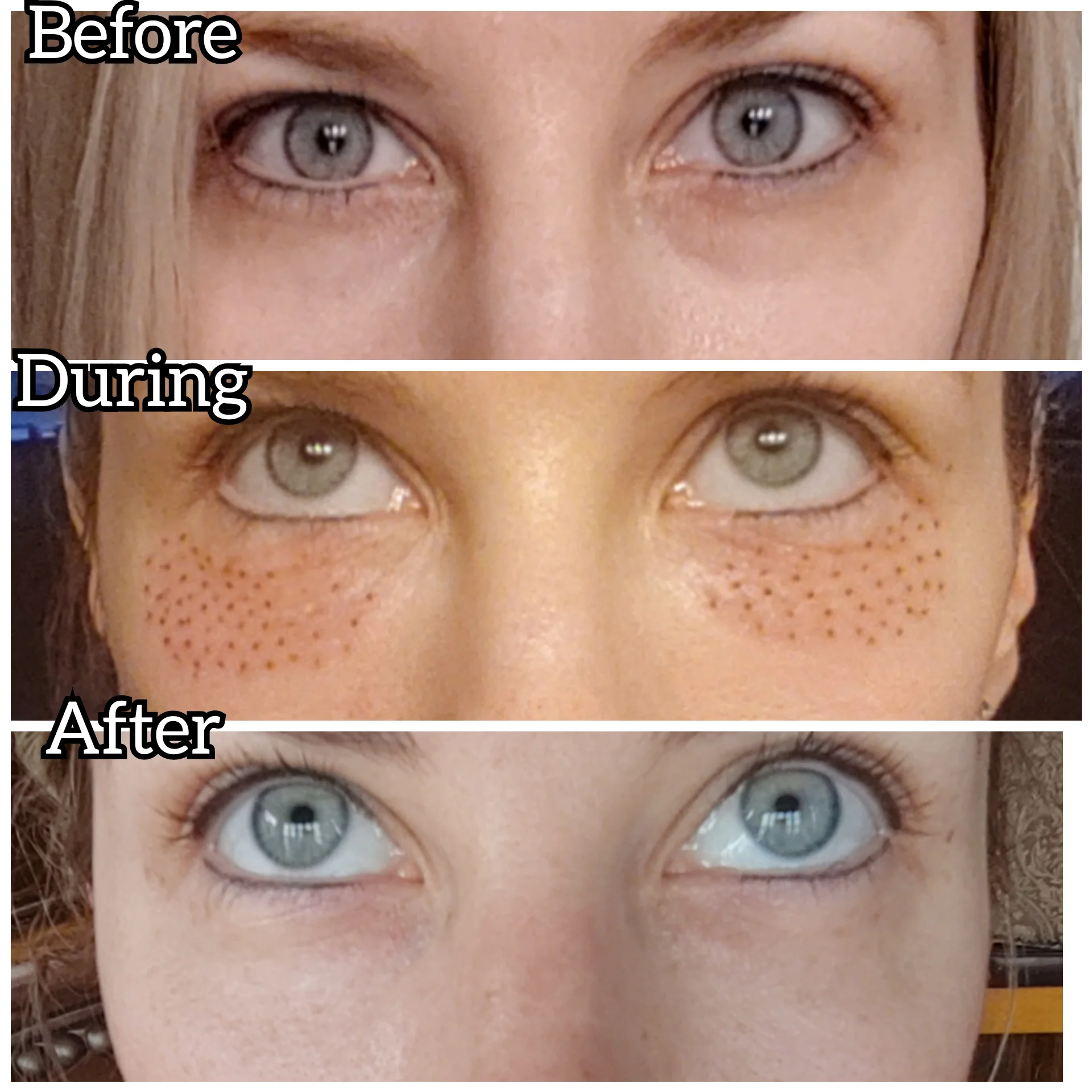 plasma fibroblast near me