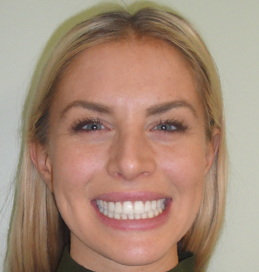 invisalign adult treatment for anna
