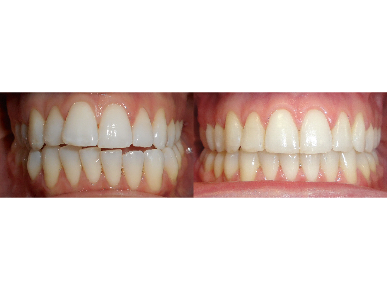 Before/After