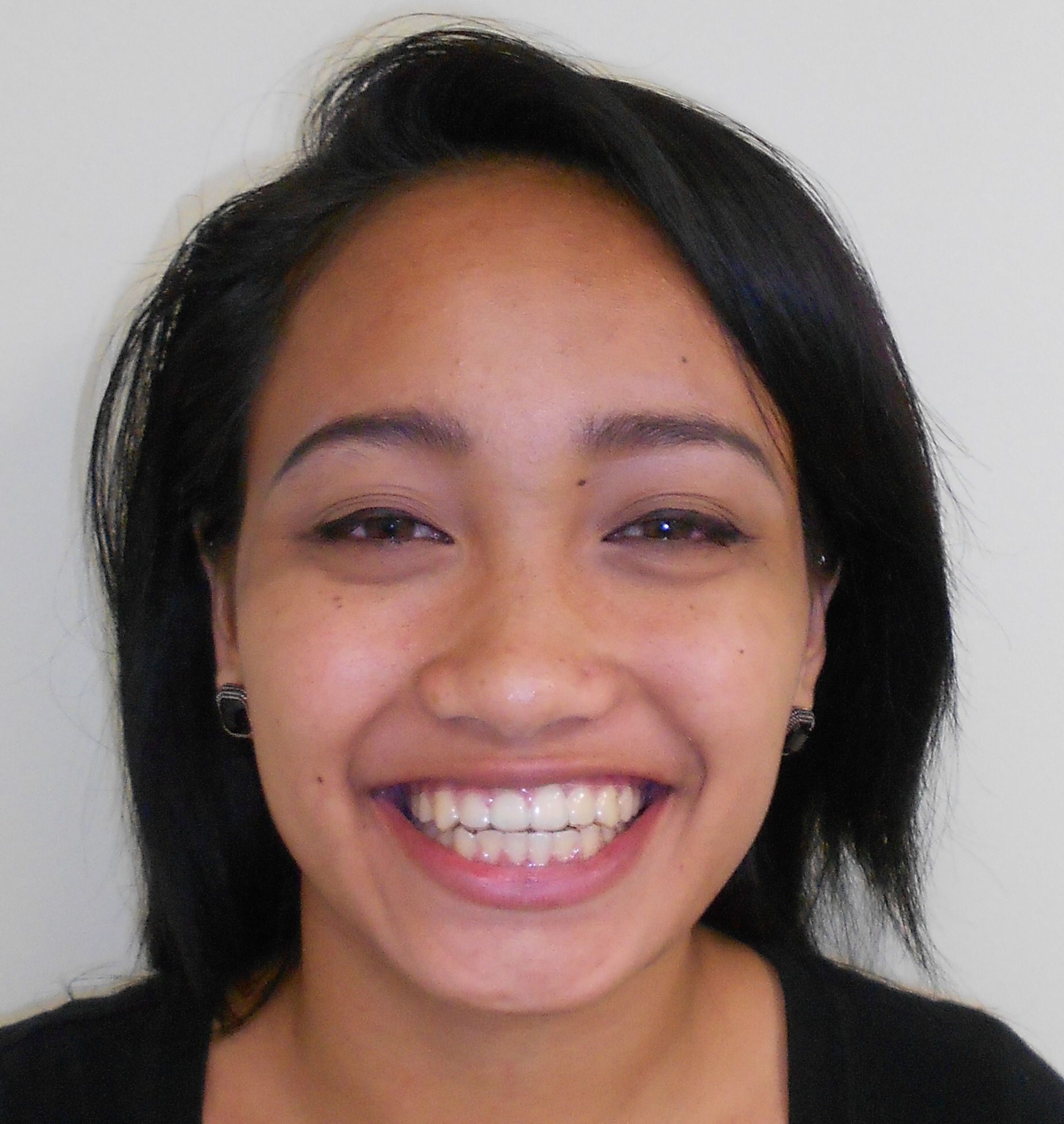 traditional braces and orthognathic surgery for Chansomally