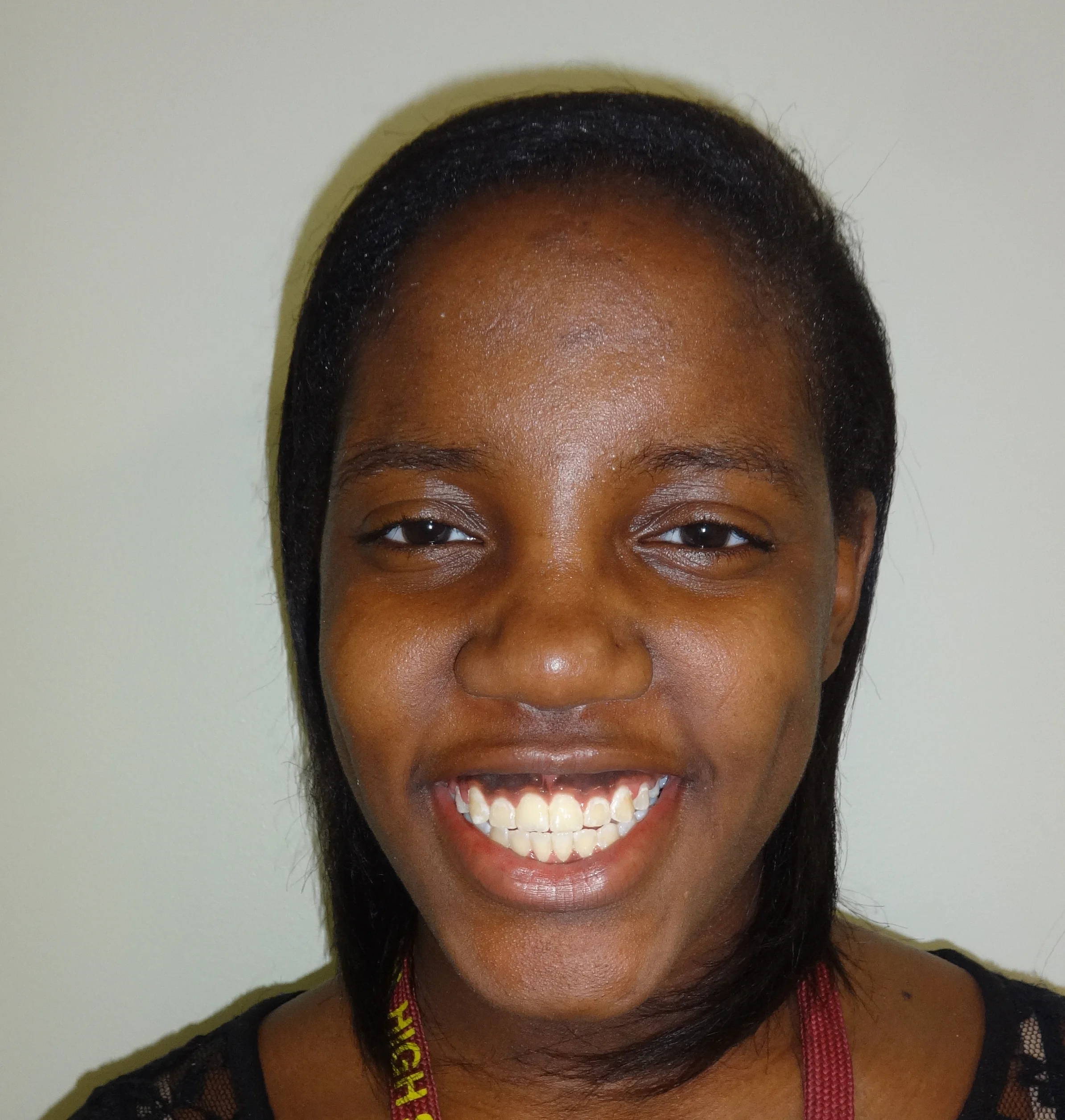 traditional braces to correct openbite for deanna