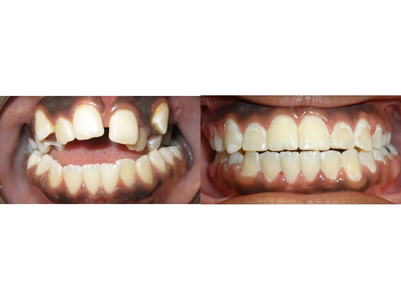 Before/After