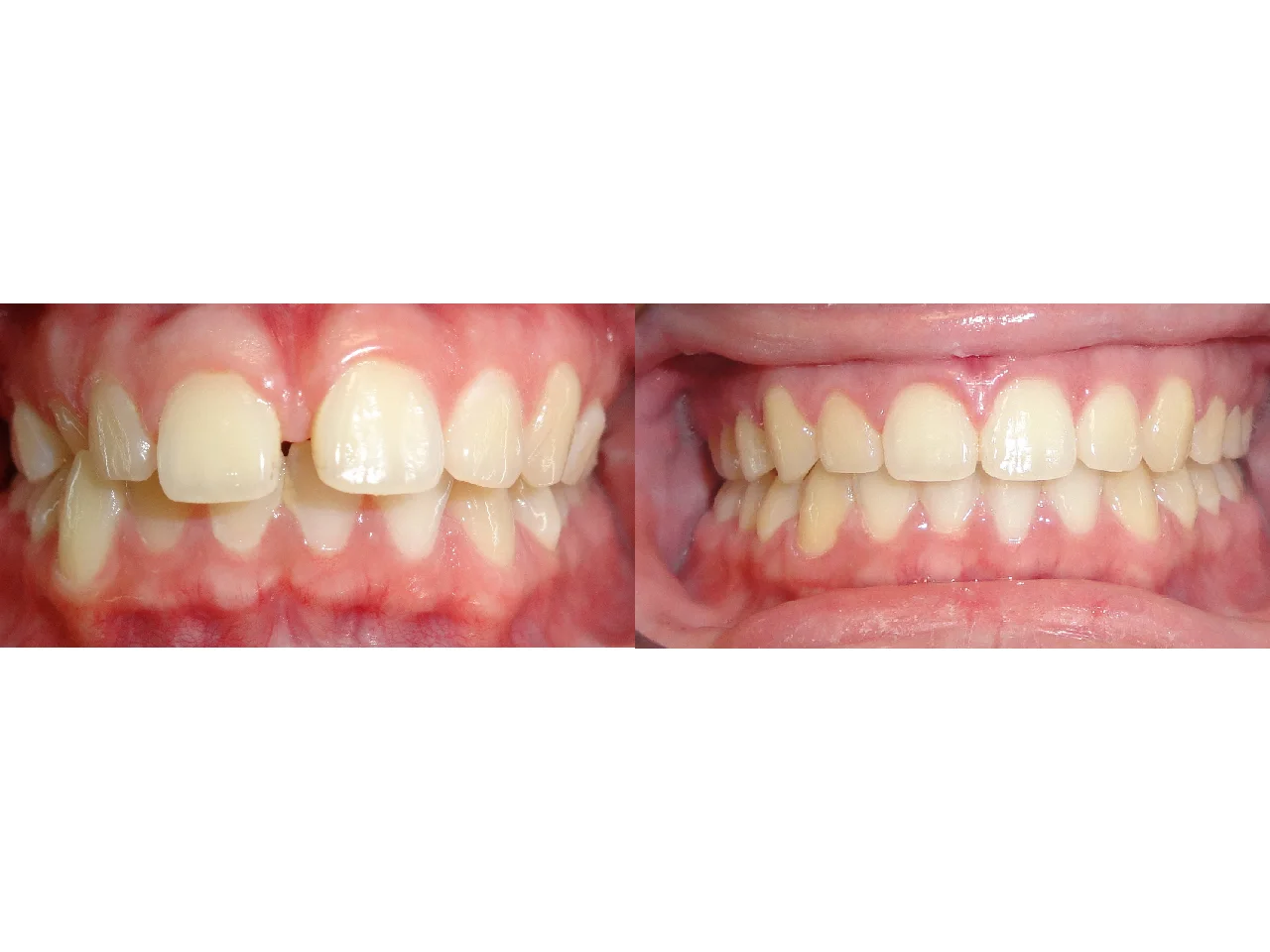 Before/After