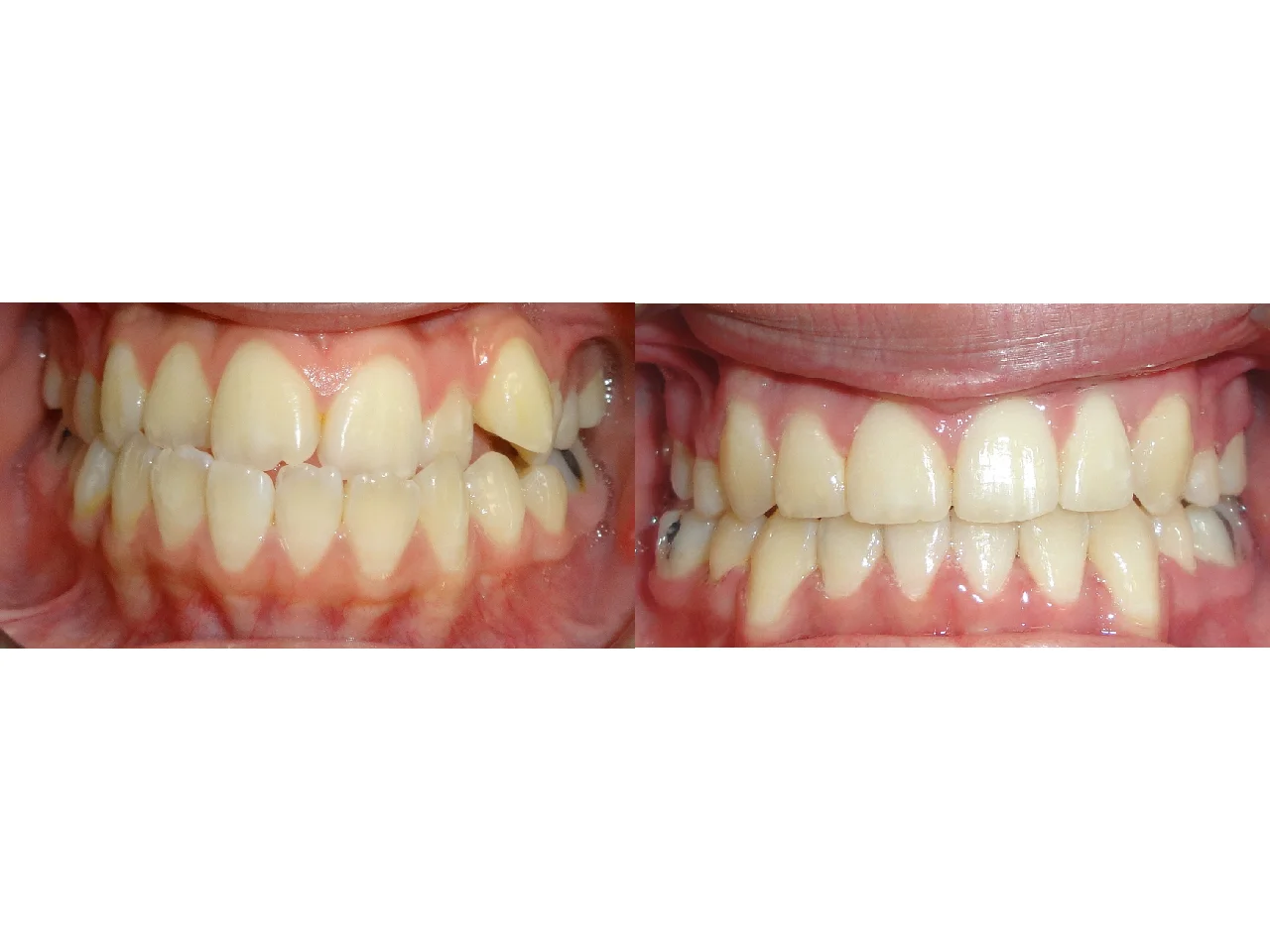 Before/After