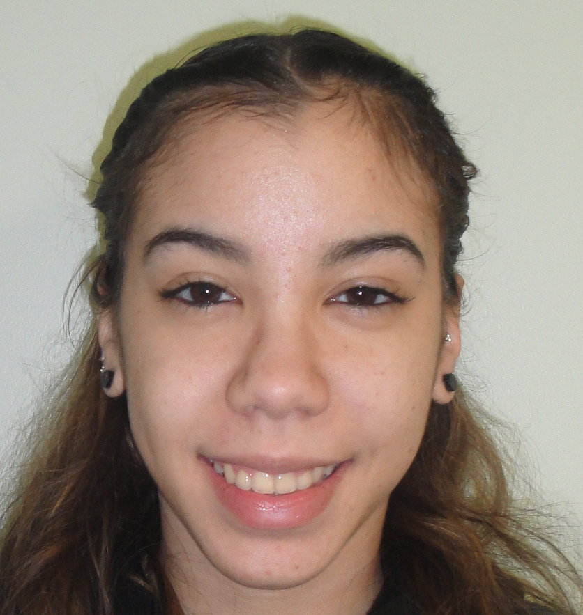 gold braces to fix overbite for jemeli
