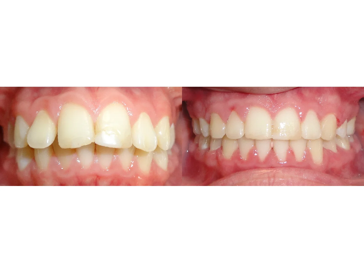 Before/After