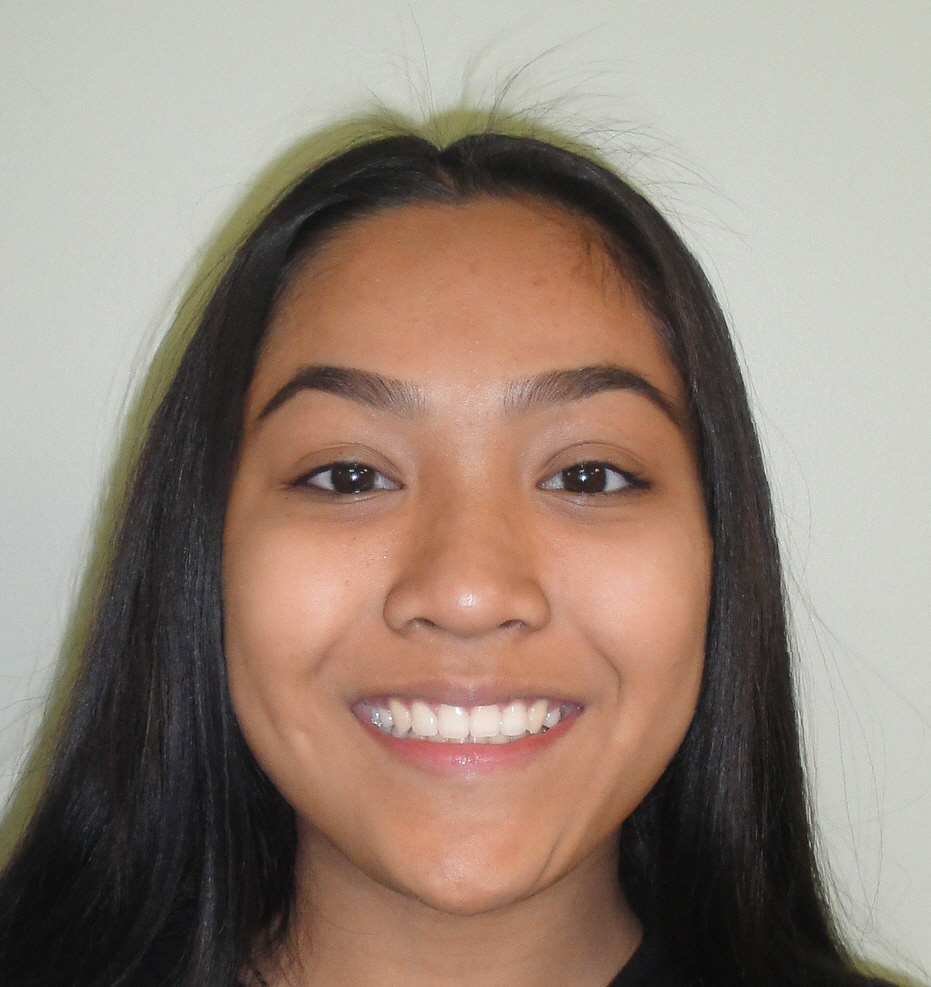 gold braces with crossbite for suczana