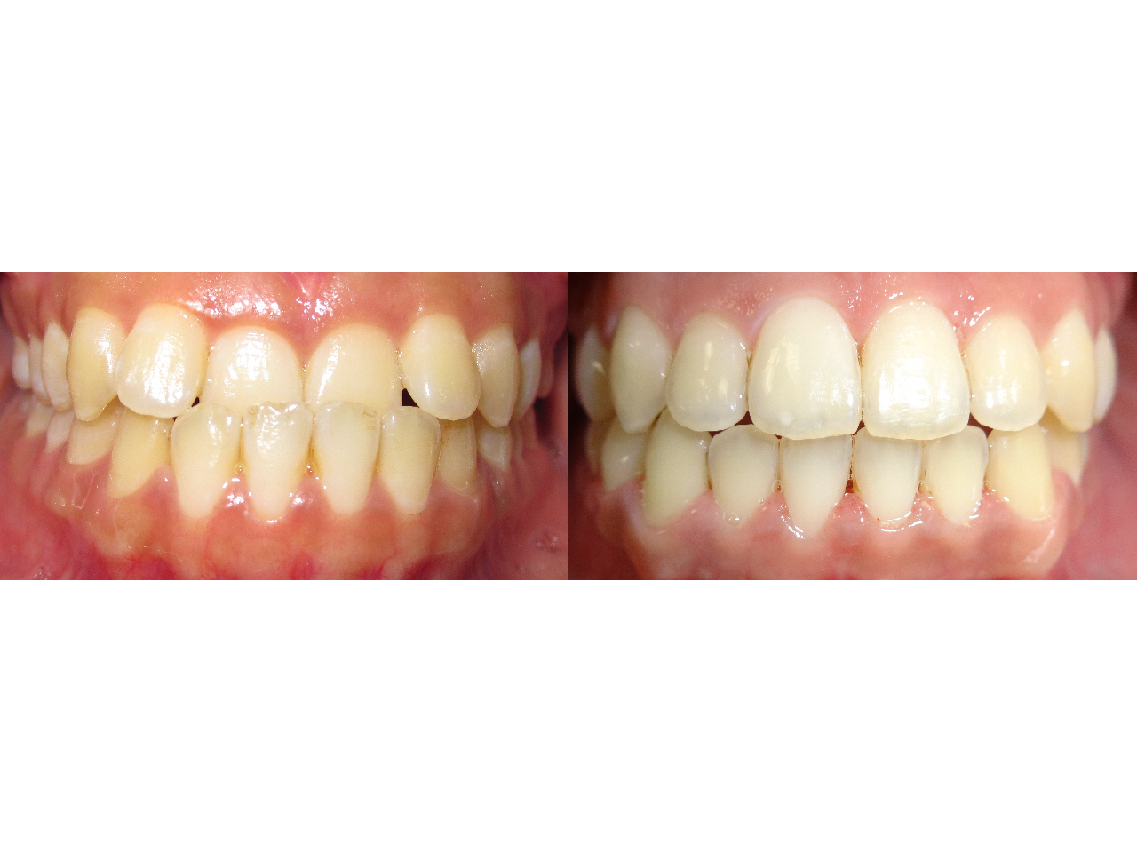 Before/After