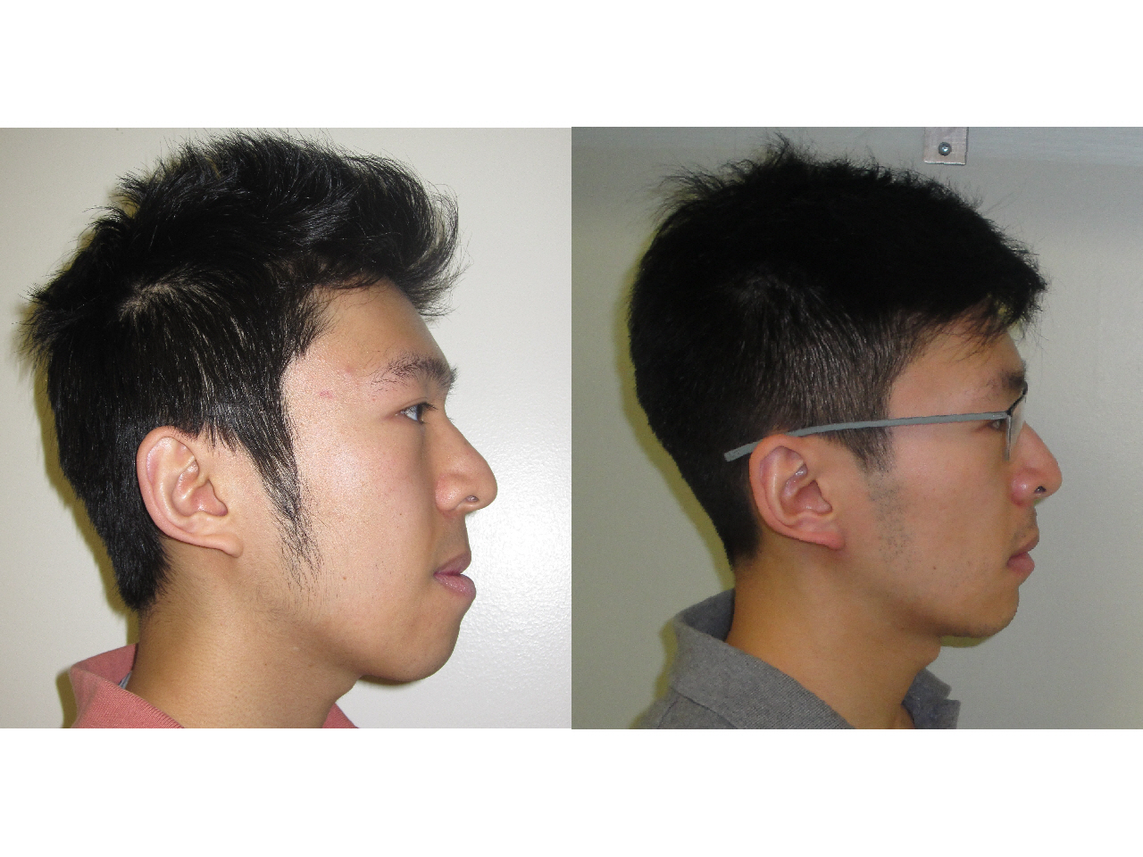 orthognathic surgery for chris