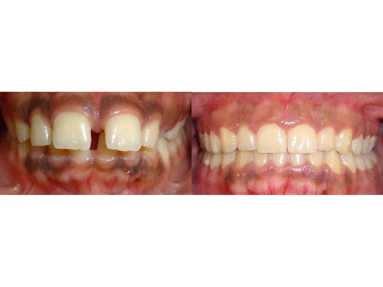 Before/After