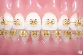 gold braces philadelphia