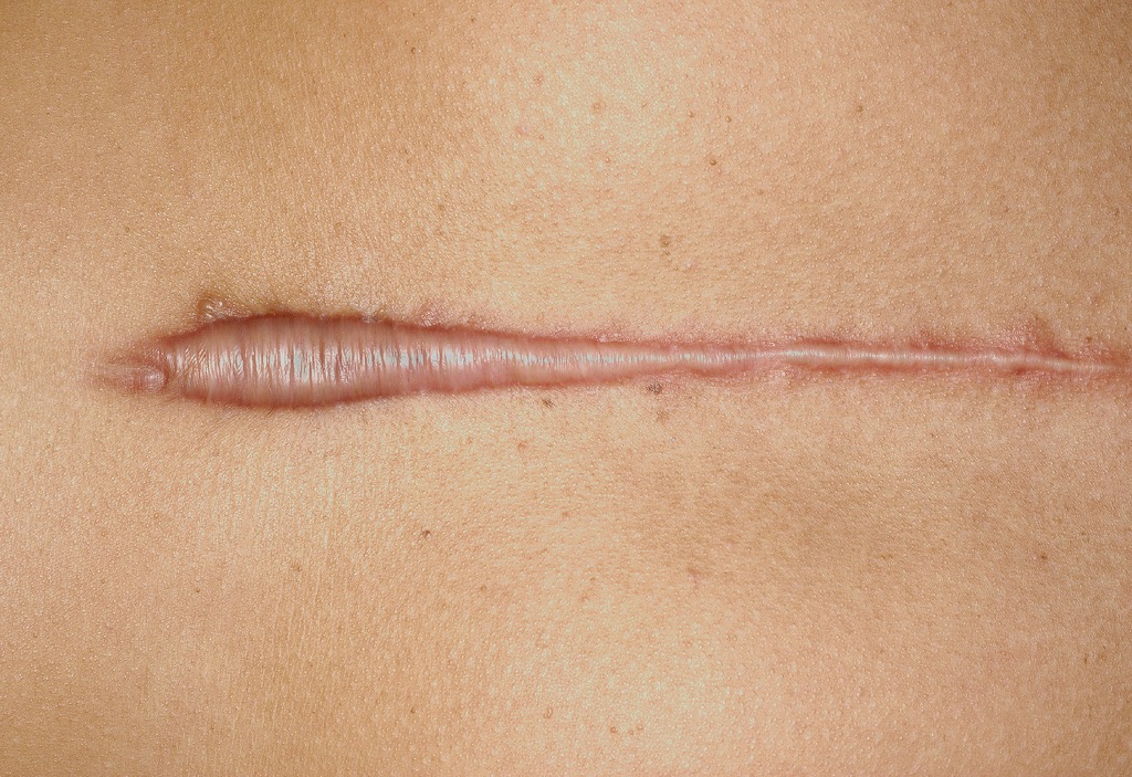 a hypertrophic scar