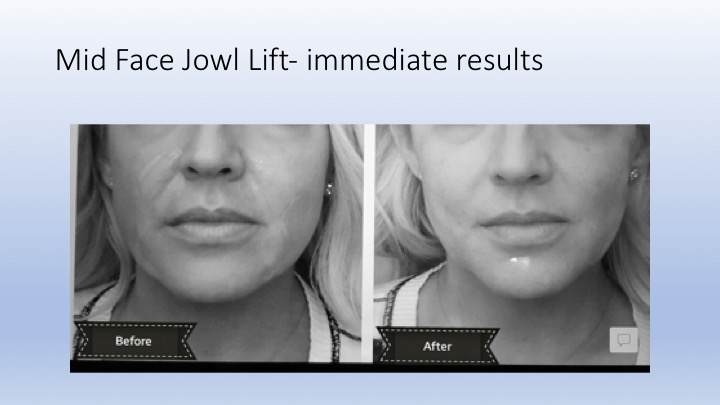 Mid Face Jowl Lift 