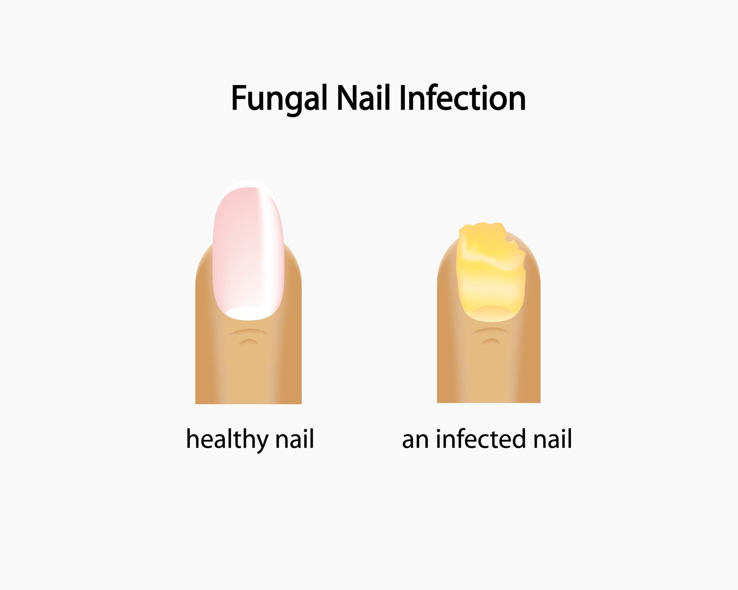Podiatrists Gaithersburg, MD Treat Fungal Toenails, Ingrown Nails and other  Toenail DIsorders — Maple Springs Foot Center, LLC