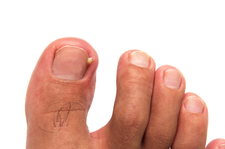 Ingrown Toenails: Causes And Prevention Tips — Maple Springs Foot Center,  LLC