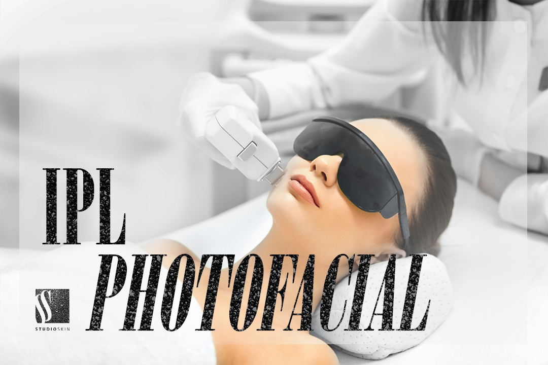 IPL Photofacial 1.2.png