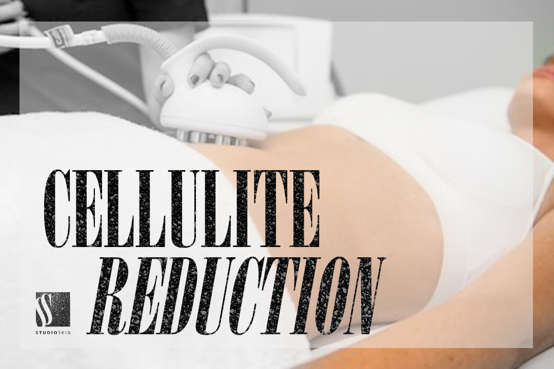 Cellulite Reduction 1.2.png