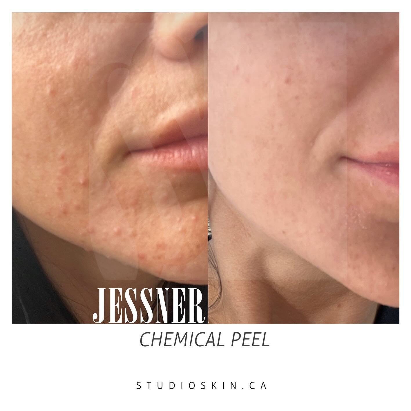 ✨The difference in only two weeks!✨

The Jessner chemical peel is a popular treatment for acne because it combines three key ingredients: salicylic acid, lactic acid, and resorcinol. These ingredients work together to exfoliate the skin, unclog pores